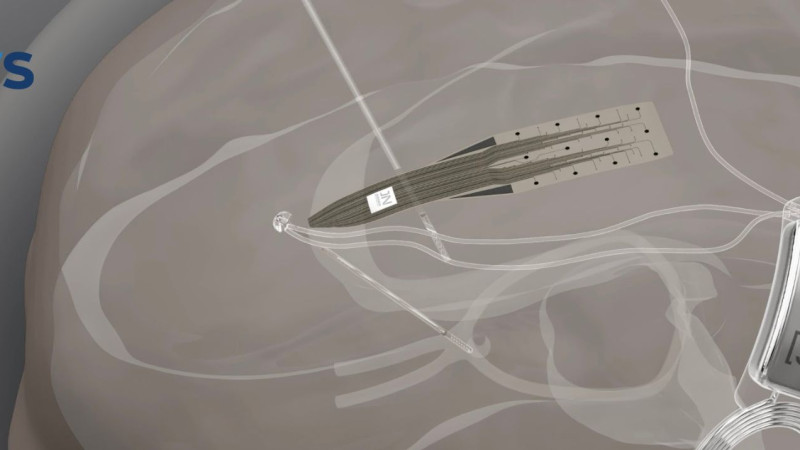 INBRAIN Neuroelectronics raises $50M Series B to advance graphene-based ...